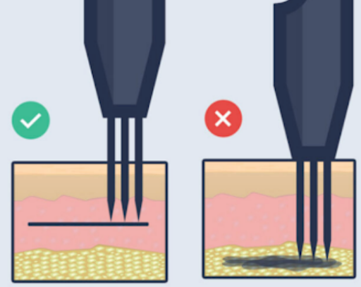 ink in the dermis layer